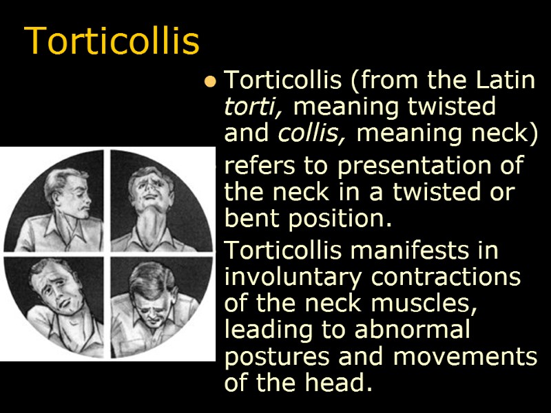 Torticollis Torticollis (from the Latin torti, meaning twisted and collis, meaning neck)  refers